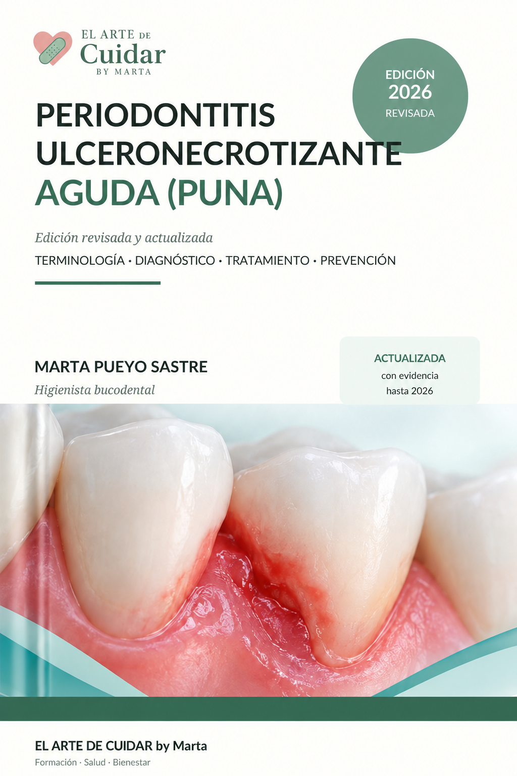 Portada del eBook Periodontitis ulceronecrotizante aguda (PUNA), edición revisada 2026, de Marta Pueyo Sastre