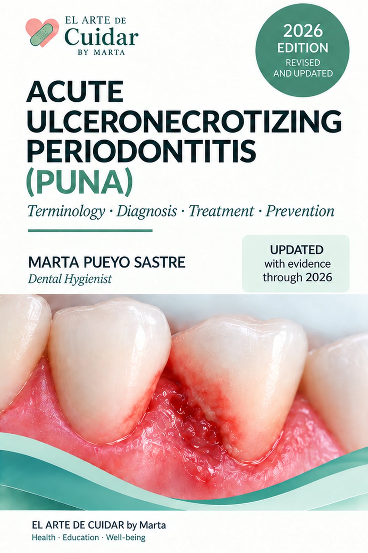 Front cover of Acute Ulceronecrotizing Periodontitis (PUNA), revised 2026 physical English edition by Marta Pueyo Sastre